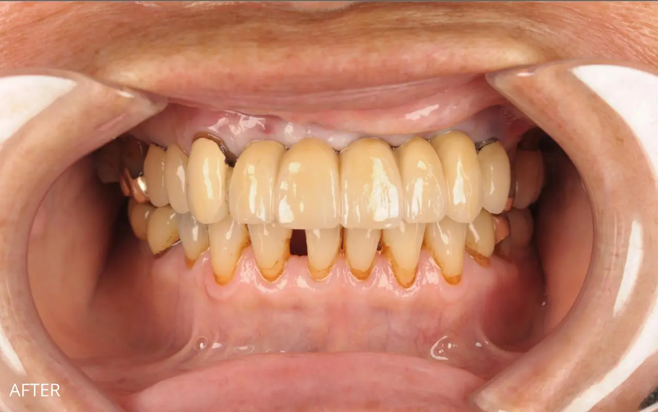 After dental implant treatment - restored smile with implant-supported bridge