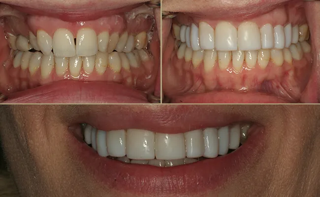 Full upper set of bonding reshaping the smile and face. extremely happy patient