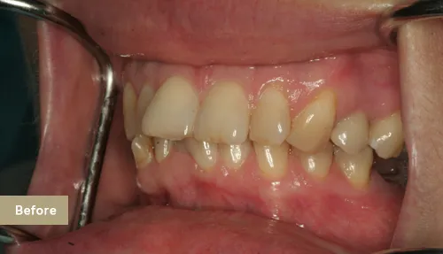 Upper veneers to better shape and alignment of teeth Before